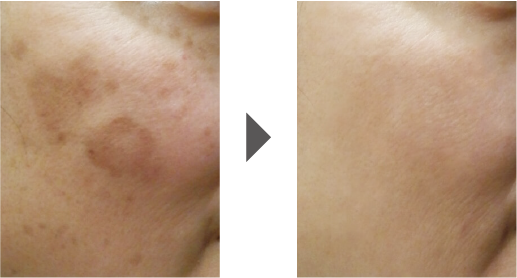 フォトブライトの症例写真 進化版フォトIPL:フォトBBL+スポットチップ