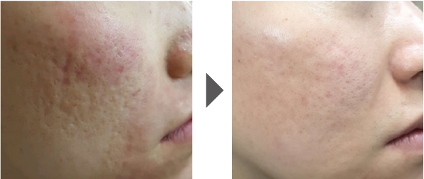 ジュベルック(Juvelook)の症例写真