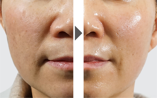 ララピールの症例写真