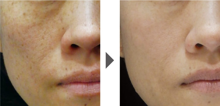 フォトブライトの症例写真 進化版フォトIPL:フォトBBL＋スポットチップ