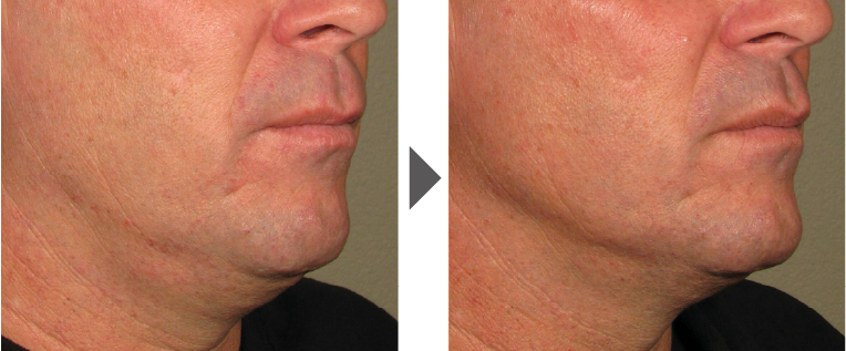 医療ハイフの症例写真