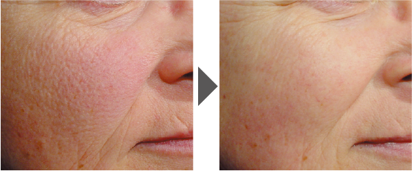 ジェネシスの症例写真