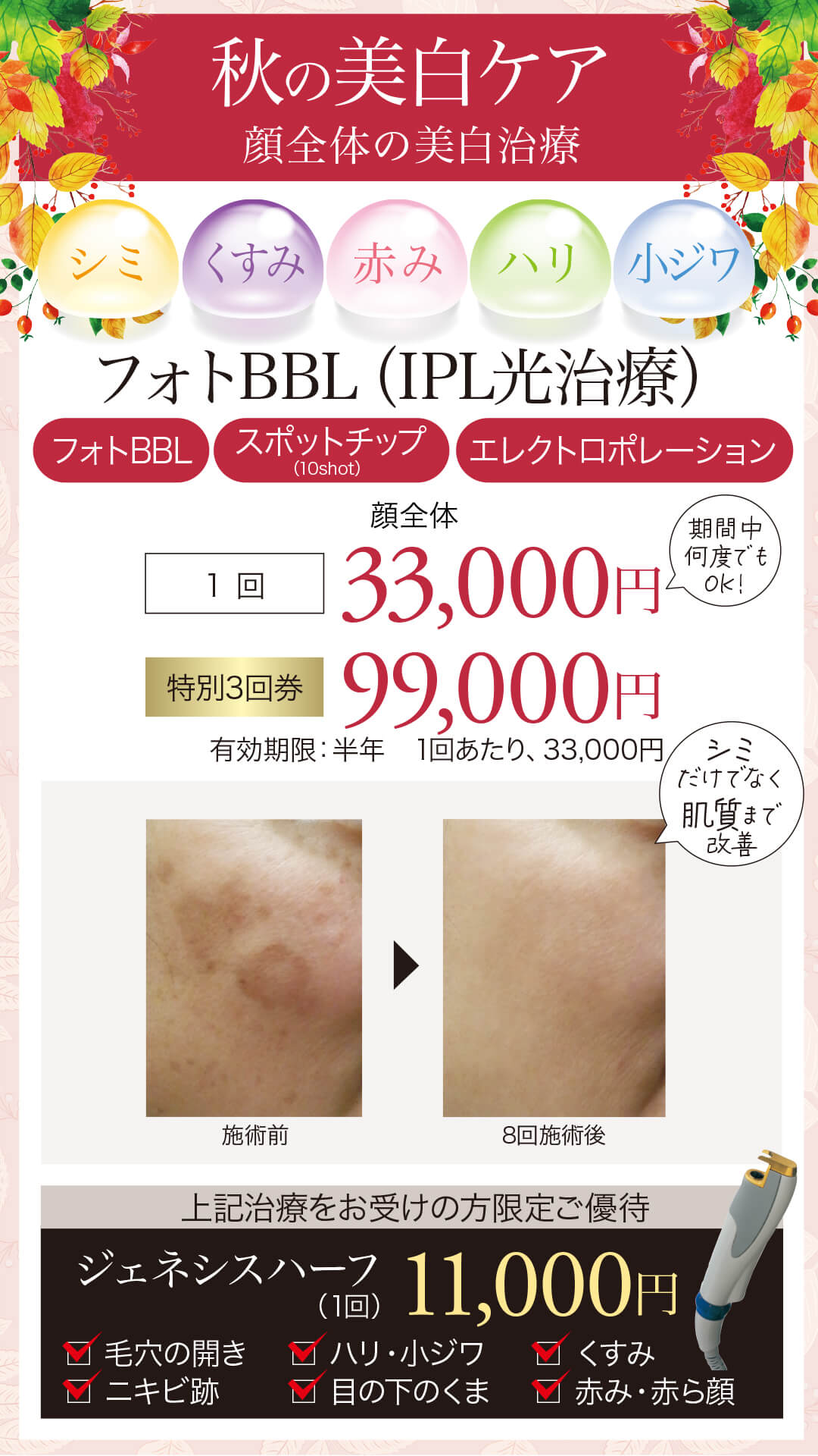 IPL光治療,フォトフェイシャル,フォトBBL,サイトンBBL,IPL,シミ,美白,赤み