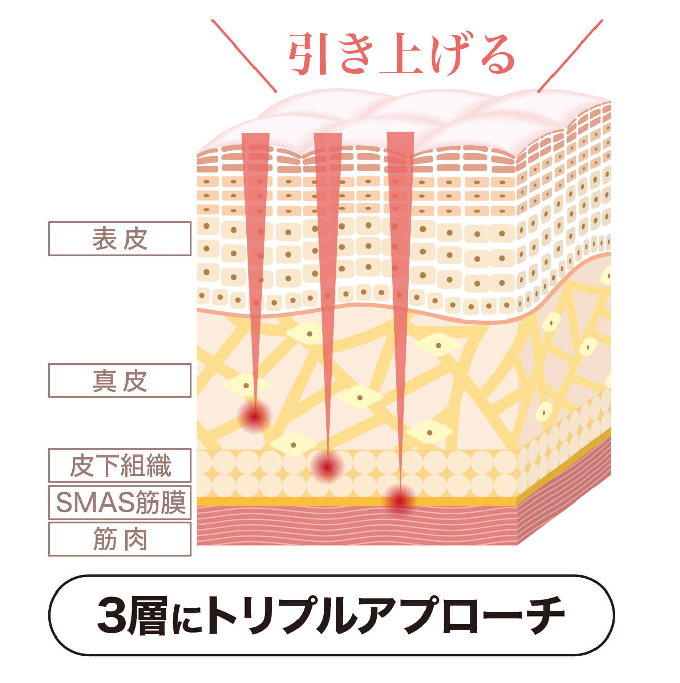 ハイフシャワー,ウルトラフォーマーMPT,医療ハイフ,HIFU,最新ハイフ,ハイフとは