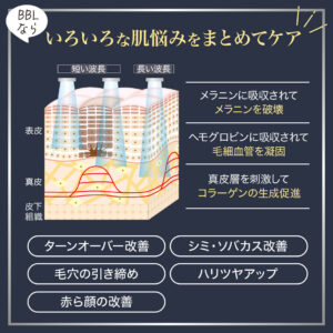 フォトフェイシャル,フォトBBL,BBL光治療,IPL治療,効果