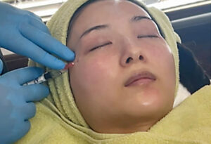 プロファイロ,PROFHILO,肌再生,スキンブースター,次世代型ヒアルロン酸,肌育注射,若返り,たるみ治療