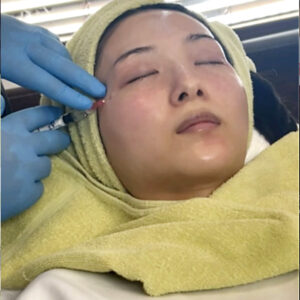 プロファイロ,PROFHILO,肌再生,スキンブースター,次世代型ヒアルロン酸,肌育注射,若返り,たるみ治療