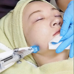 ジュベルック,juvelook,水光ボトックス,水光注射