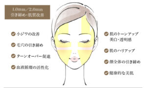 ハイフシャワー,ウルトラフォーマーMPT,医療ハイフ,HIFU,最新ハイフ