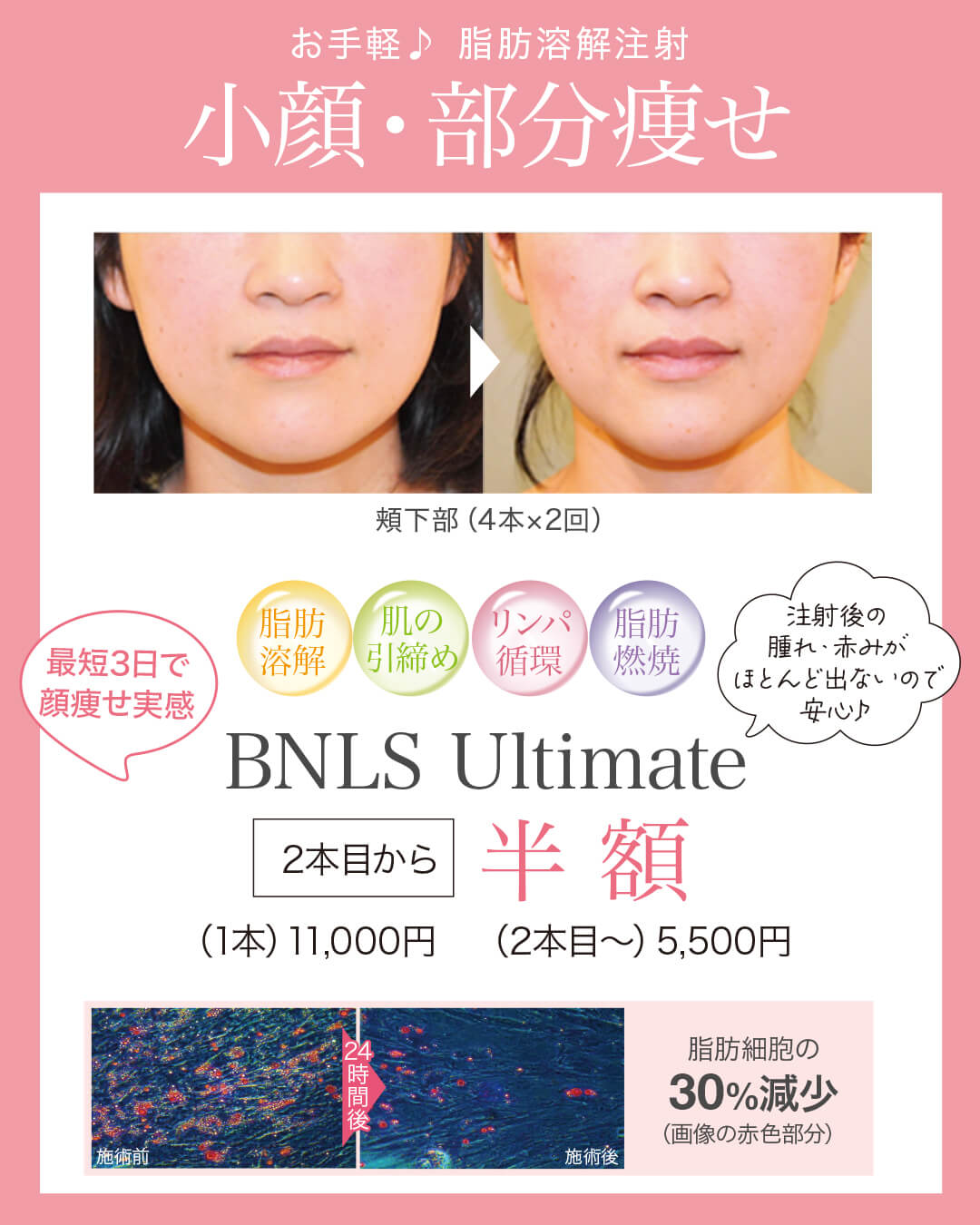 BNLS Ultimate,脂肪溶解注射,小顔,部分痩せ,団子鼻