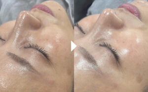 ララピール,症例写真