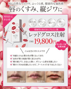 レッドグロス注射,ヒアルロン酸,LIP STAR,唇専用ヒアルロン酸