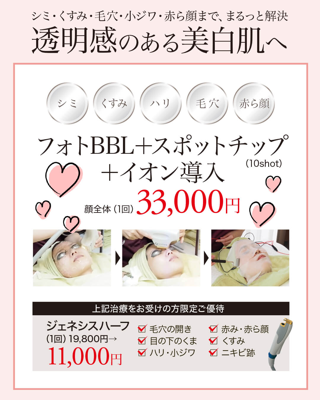 IPL光治療,フォトフェイシャル,フォトBBL,IPL,シミ,美白,赤み,イオン導入,ジェネシス