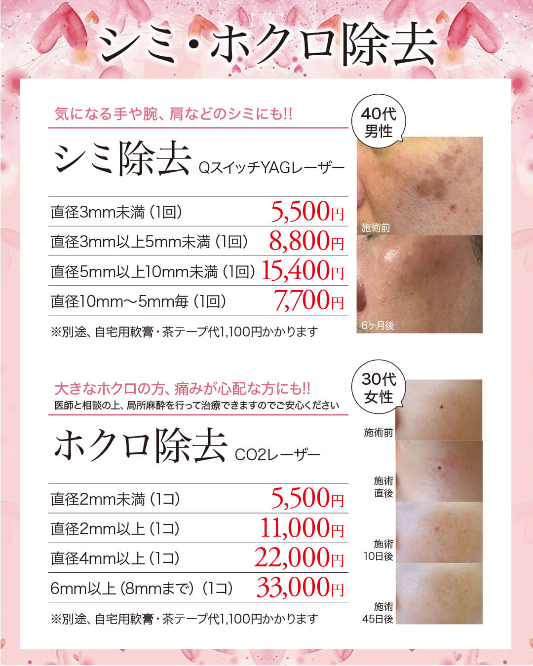 シミ除去,シミレーザー,QスイッチYAGレーザー,ホクロ除去,CO2レーザー,炭酸ガスレーザー